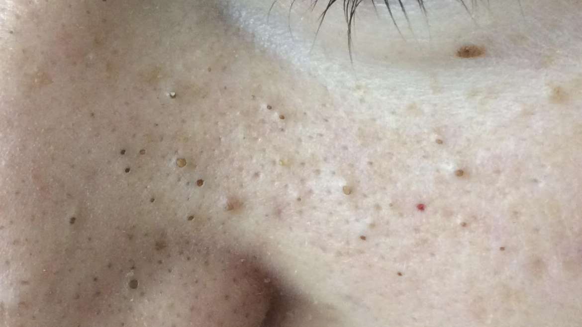 Tinejdžerske akne – intervju s našim dermatologom