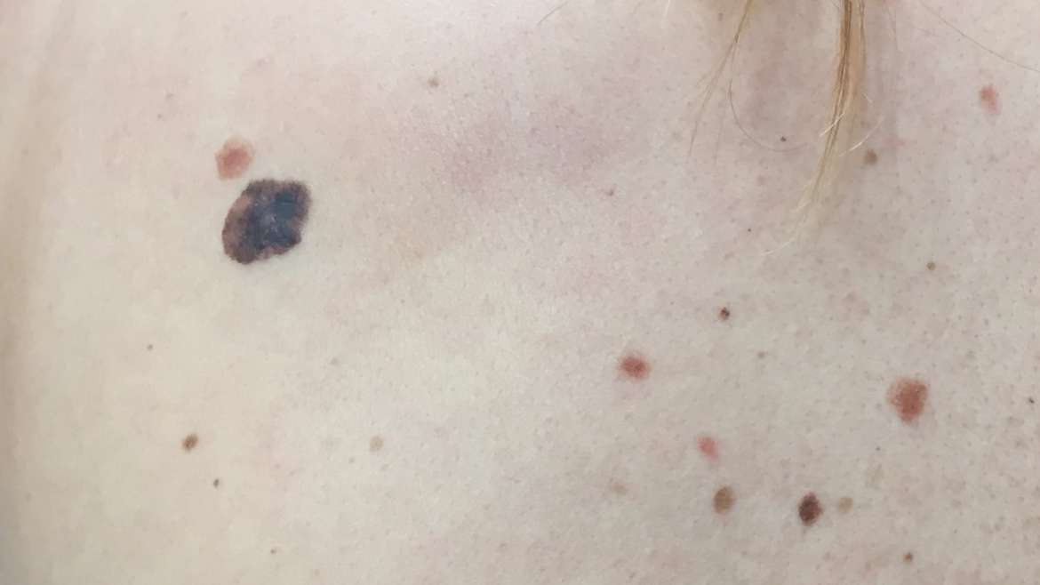 Madeži na koži i melanom – najčešća pitanja