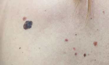 Madeži na koži i melanom – najčešća pitanja