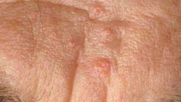 Sebacealna hiperplazija