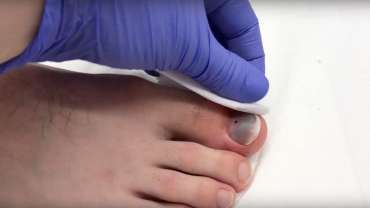 Hematoma ispod nokta: pražnjenje fenestracijom