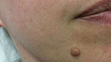 Upute za pacijente nakon uklanjanja kožnih izraslina