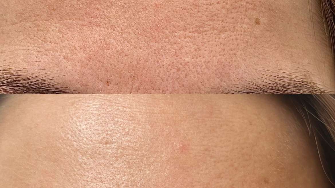 Što je bolje protiv bora na čelu – botoks ili laser?