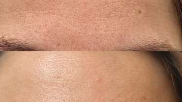 Što je bolje protiv bora na čelu – botoks ili laser?