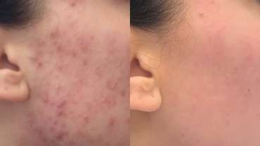 Dr. Vesna Tlaker: Akne su kožna bolest koju možemo učinkovito kontrolirati