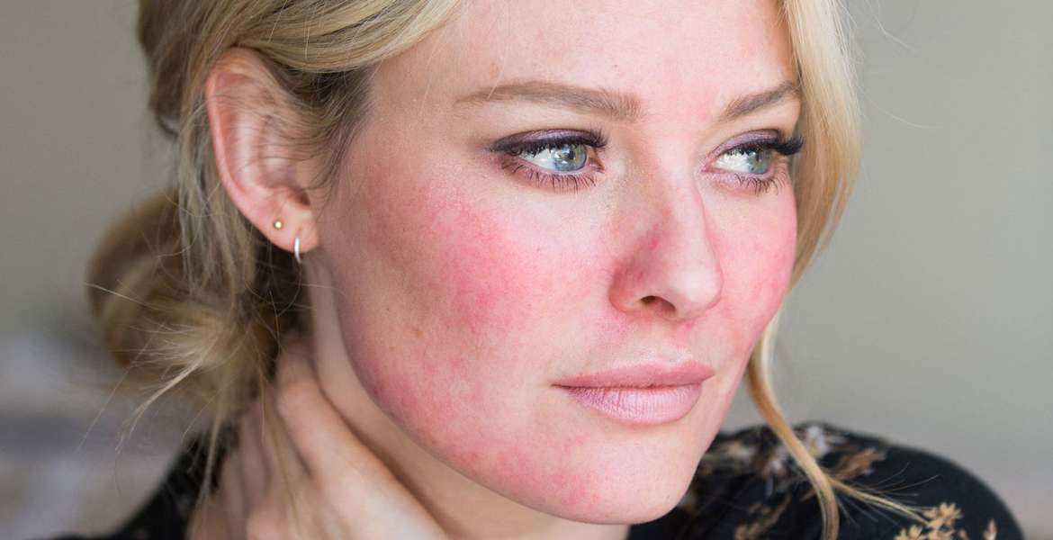 Rosacea: kožna bolest koju možemo učinkovito ublažiti