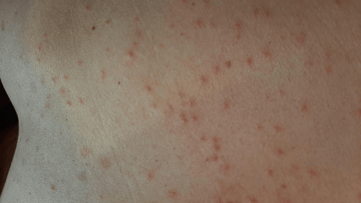 Trombidijaza – iznenadni osip sličan alergiji