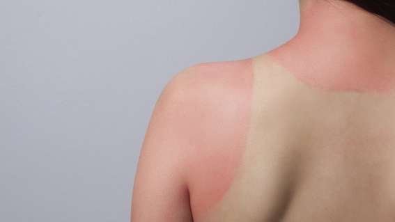 Sunčane opekline – mjere i savjeti