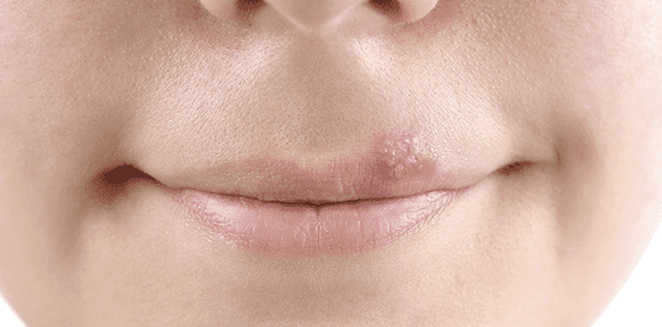 Herpes – najčešća pitanja