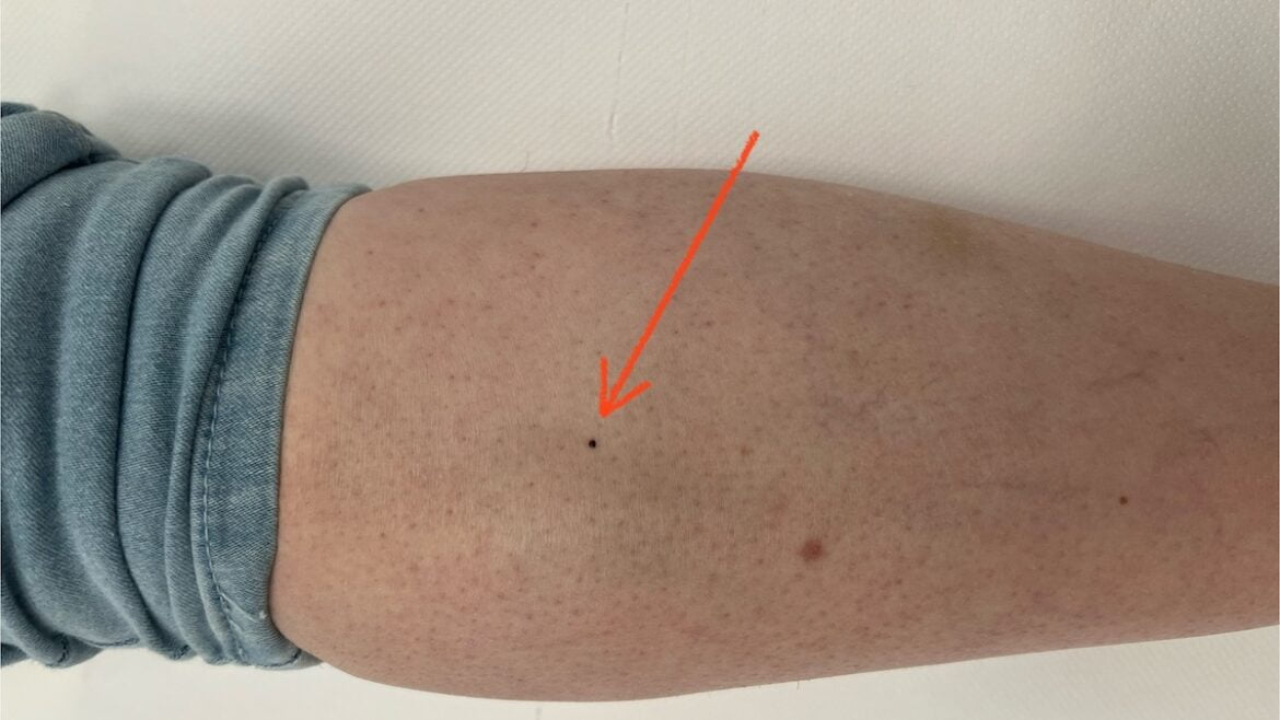 Crna točka na koži – kviz