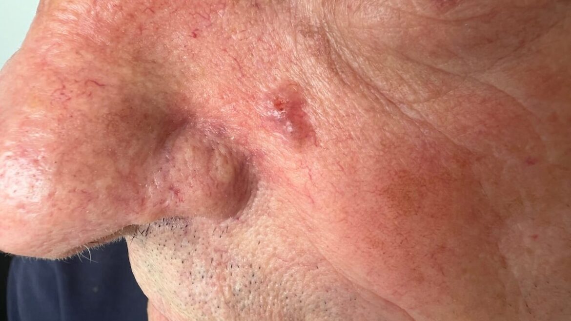 Ružičasti čvorić na licu – klinički kviz