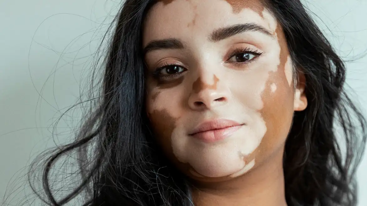 Učinkovit lijek za vitiligo– napokon je dostupan i u Sloveniji!